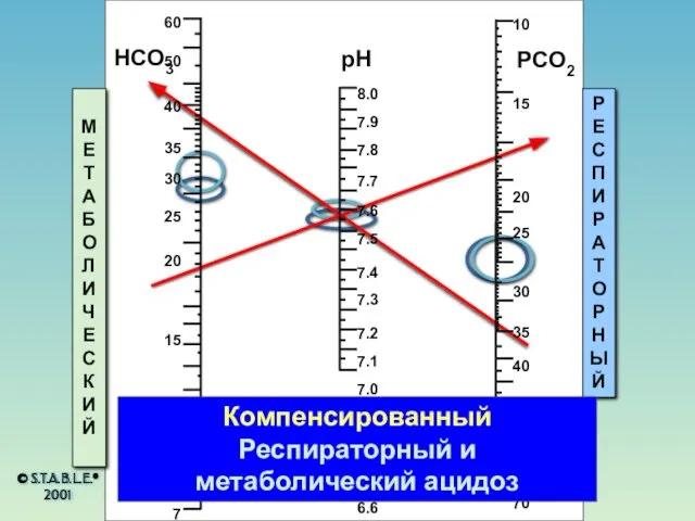 HCO3 pH PCO2 МЕТАБОЛИЧЕСКИЙ РЕСПИРАТОРНЫЙ Компенсированный Респираторный и метаболический ацидоз © S.T.A.B.L.E.® 2001