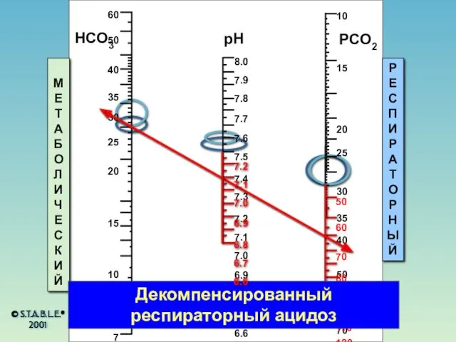 HCO3 pH PCO2 МЕТАБОЛИЧЕСКИЙ РЕСПИРАТОРНЫЙ Декомпенсированный респираторный ацидоз © S.T.A.B.L.E.® 2001