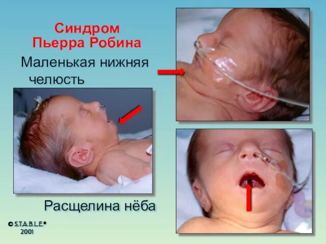 Синдром Пьерра Робина Маленькая нижняя челюсть Расщелина нёба © S.T.A.B.L.E.® 2001