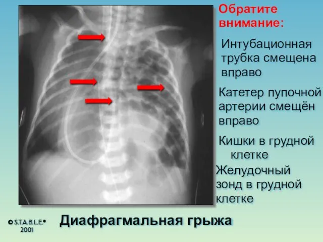 Обратите внимание: Катетер пупочной артерии смещён вправо Кишки в грудной