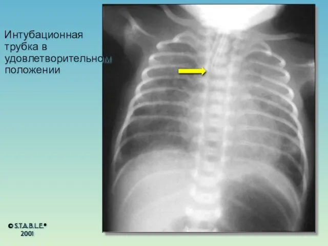 Интубационная трубка в удовлетворительном положении © S.T.A.B.L.E.® 2001