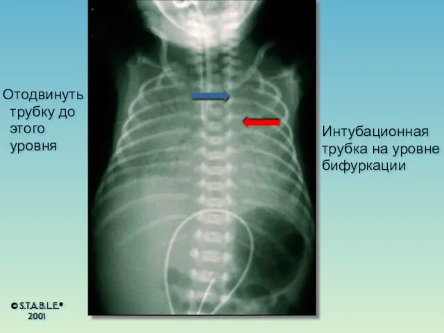 Интубационная трубка на уровне бифуркации Отодвинуть трубку до этого уровня © S.T.A.B.L.E.® 2001