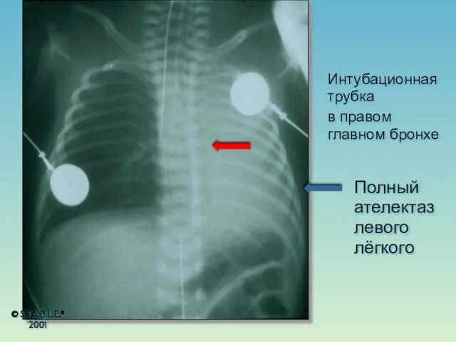 Интубационная трубка в правом главном бронхе Полный ателектаз левого лёгкого © S.T.A.B.L.E.® 2001