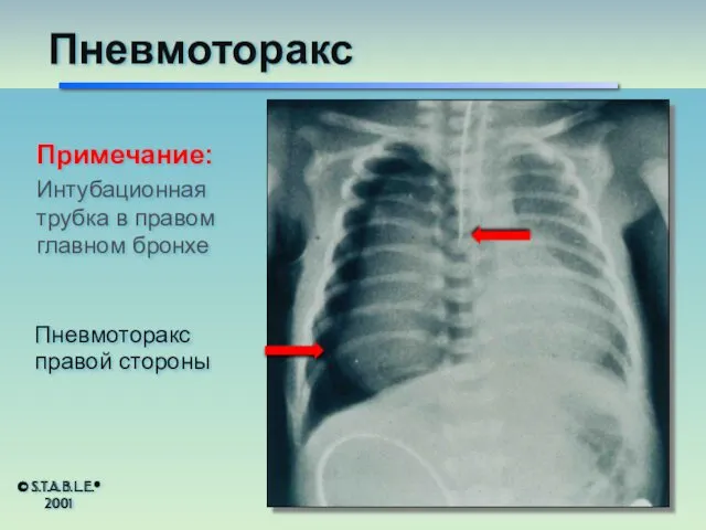 Примечание: Интубационная трубка в правом главном бронхе Пневмоторакс правой стороны Пневмоторакс © S.T.A.B.L.E.® 2001