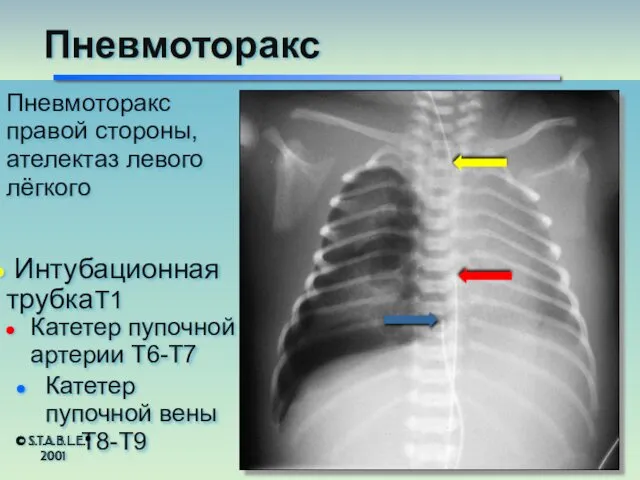 Пневмоторакс правой стороны, ателектаз левого лёгкого Катетер пупочной артерии T6-T7