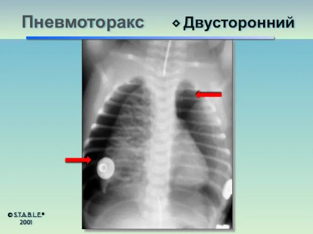 Пневмоторакс ⬥ Двусторонний © S.T.A.B.L.E.® 2001