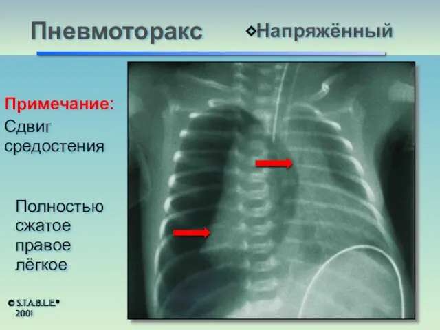 © S.T.A.B.L.E.® 2001 Пневмоторакс ⬥Напряжённый Примечание: Сдвиг средостения Полностью сжатое правое лёгкое