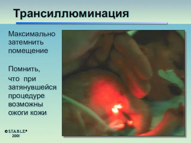 Трансиллюминация Максимально затемнить помещение Помнить, что при затянувшейся процедуре возможны ожоги кожи © S.T.A.B.L.E.® 2001