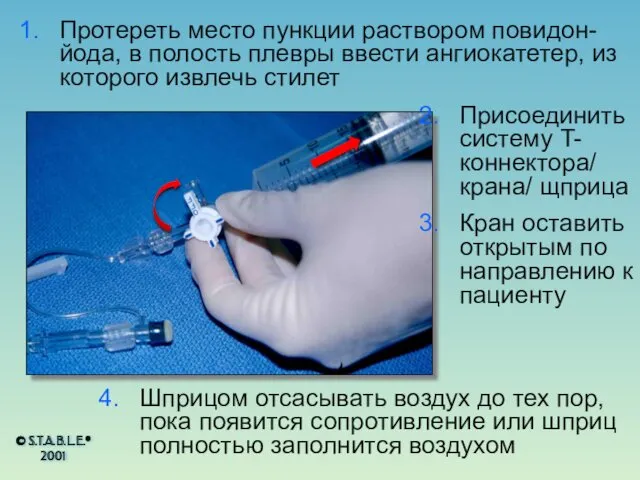 Протереть место пункции раствором повидон-йода, в полость плевры ввести ангиокатетер,