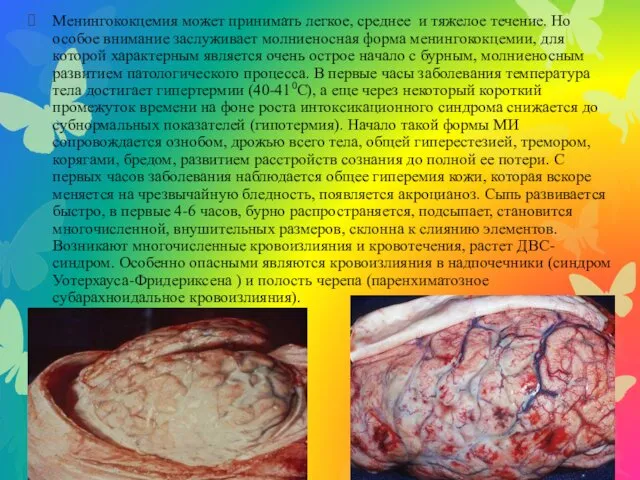 Менингококцемия может принимать легкое, среднее и тяжелое течение. Но особое