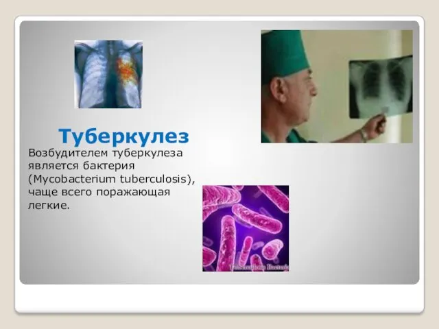 Туберкулез Возбудителем туберкулеза является бактерия (Mycobacterium tuberculosis), чаще всего поражающая легкие.