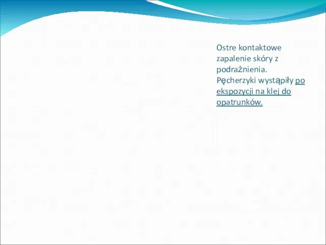 Ostre kontaktowe zapalenie skóry z podrażnienia. Pęcherzyki wystąpiły po ekspozycji na klej do opatrunków.