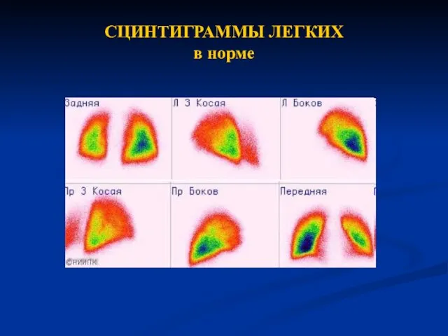 СЦИНТИГРАММЫ ЛЕГКИХ в норме