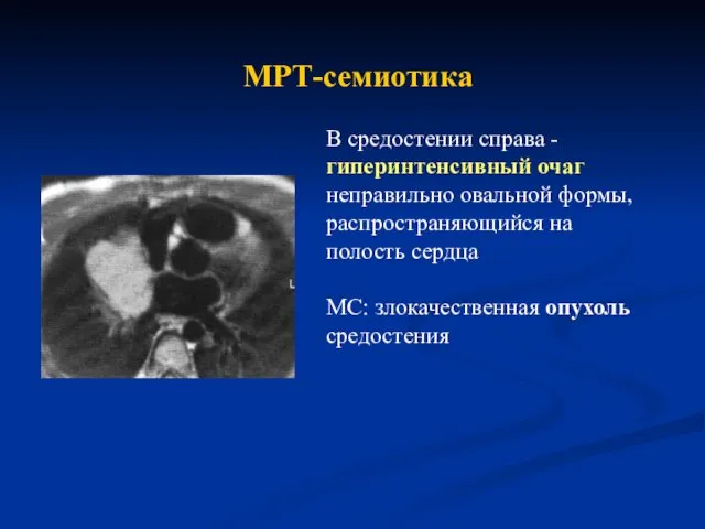 В средостении справа - гиперинтенсивный очаг неправильно овальной формы, распространяющийся