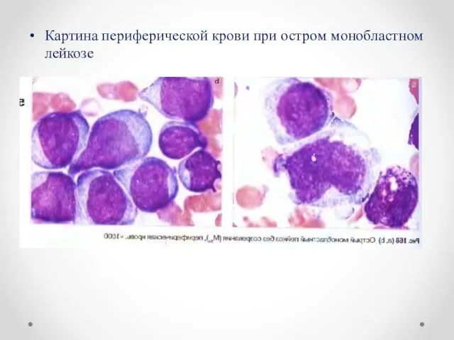 Картина периферической крови при остром монобластном лейкозе