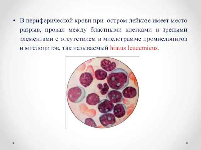 В периферической крови при остром лейкозе имеет место разрыв, провал между бластными клетками
