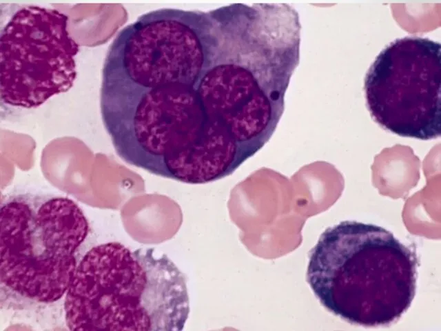 Картина крови при остром миелобластном лейкозе