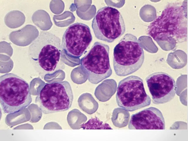 Картина крови при остром лимфобластном лейкозе