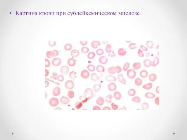 Картина крови при сублейкемическом миелозе