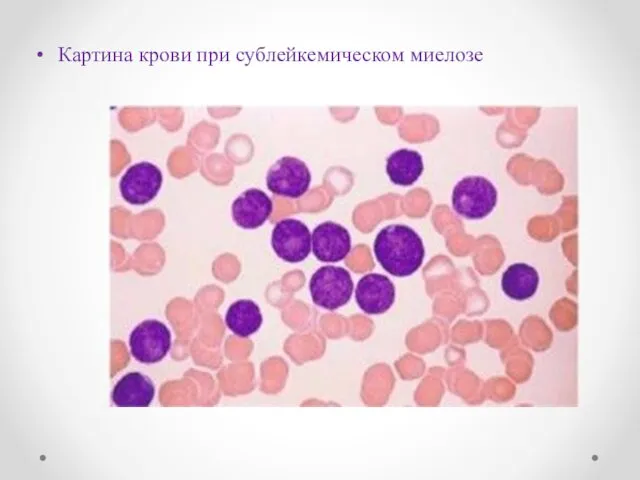 Картина крови при сублейкемическом миелозе