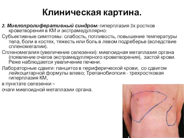 Клиническая картина. 2. Миелопролиферативный синдром: гиперплазия 3х ростков кроветворения в