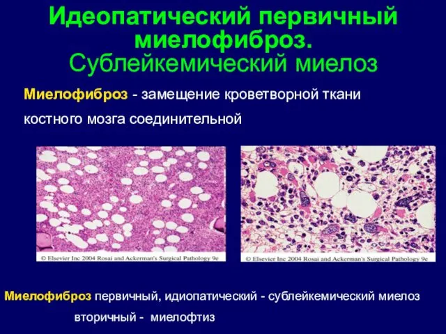 Миелофиброз - замещение кроветворной ткани костного мозга соединительной Идеопатический первичный