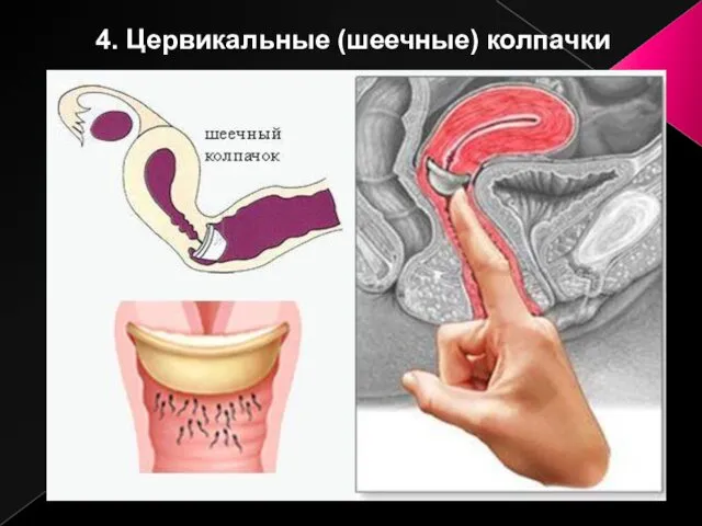 4. Цервикальные (шеечные) колпачки