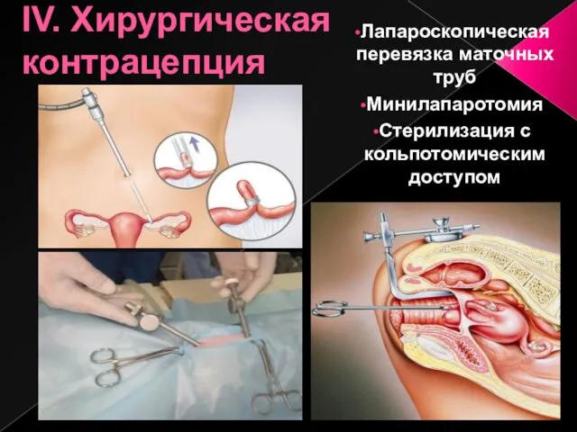 IV. Хирургическая контрацепция Лапароскопическая перевязка маточных труб Минилапаротомия Стерилизация с кольпотомическим доступом
