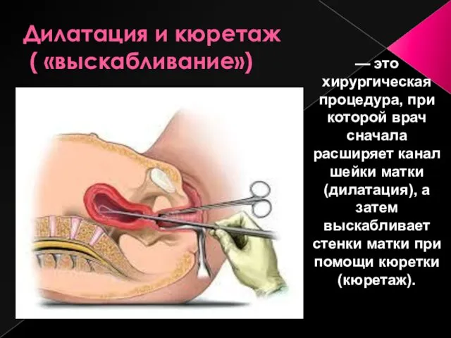 Дилатация и кюретаж ( «выскабливание») — это хирургическая процедура, при которой врач сначала
