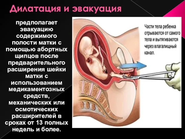 Дилатация и эвакуация предполагает эвакуацию содержимого полости матки с помощью абортных щипцов после