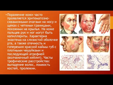 Поражение кожи часто проявляется эритематозно-сквамозными очагами на носу и щеках