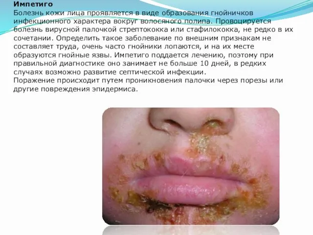 Импетиго Болезнь кожи лица проявляется в виде образования гнойничков инфекционного характера вокруг волосяного