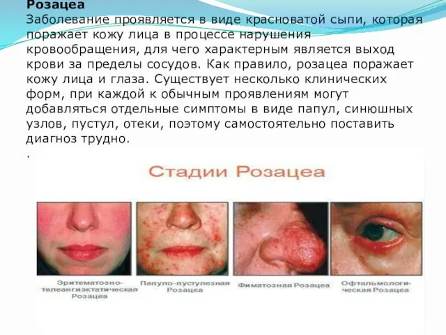 Розацеа Заболевание проявляется в виде красноватой сыпи, которая поражает кожу лица в процессе