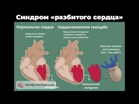 Синдром «разбитого сердца»