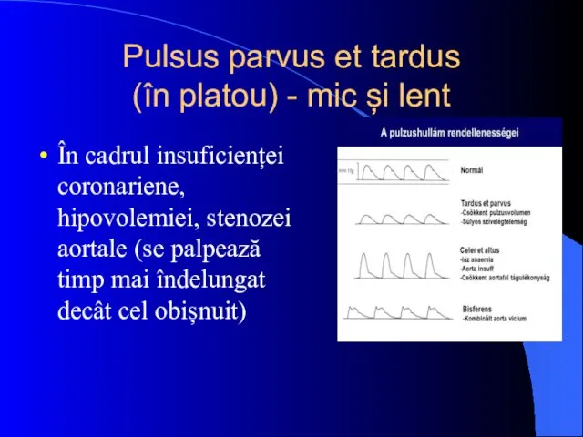 Pulsus parvus et tardus (în platou) - mic și lent