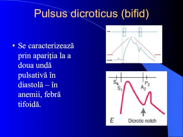 Pulsus dicroticus (bifid) Se caracterizează prin apariția la a doua