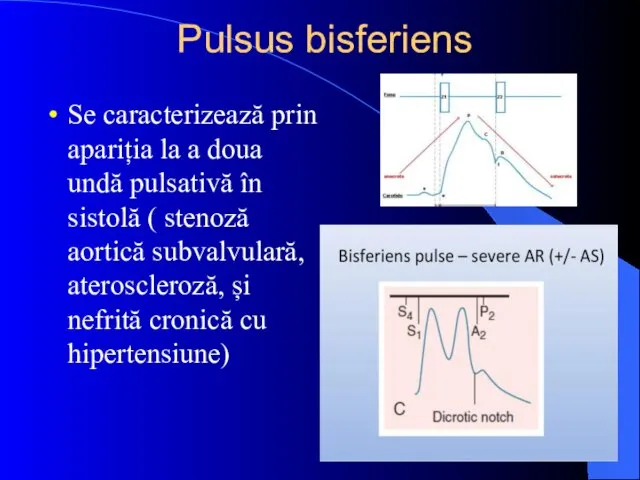 Pulsus bisferiens Se caracterizează prin apariția la a doua undă