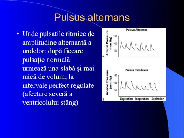 Pulsus alternans Unde pulsatile ritmice de amplitudine alternantă a undelor: