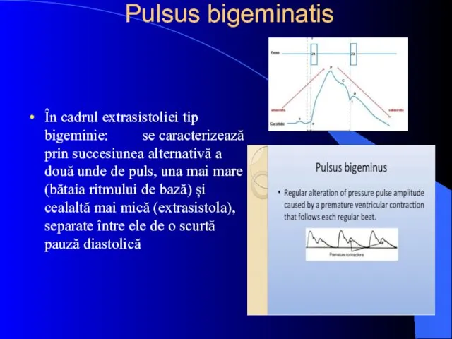 Pulsus bigeminatis În cadrul extrasistoliei tip bigeminie: se caracterizează prin