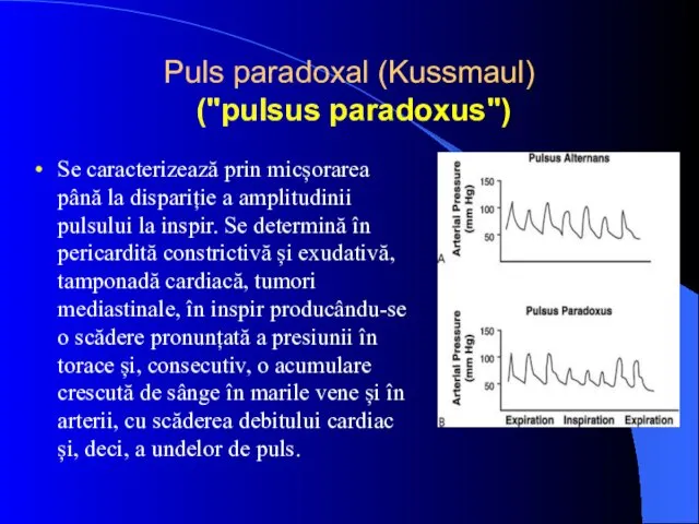 Puls paradoxal (Kussmaul) ("pulsus paradoxus") Se caracterizează prin micșorarea până