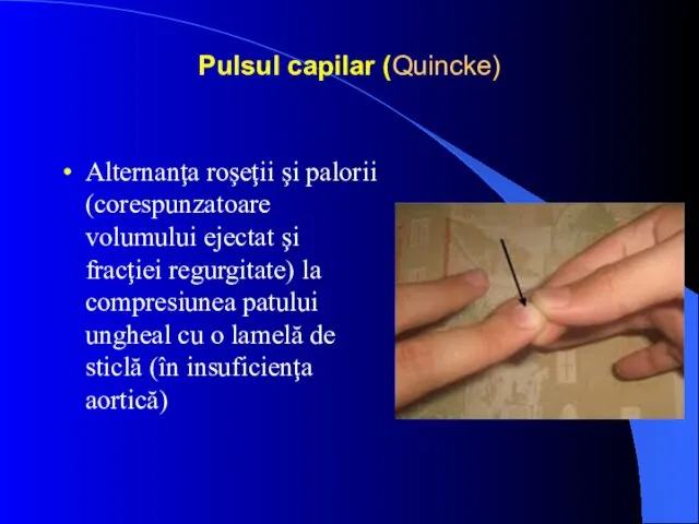 Pulsul capilar (Quincke) Alternanţa roşeţii şi palorii (corespunzatoare volumului ejectat