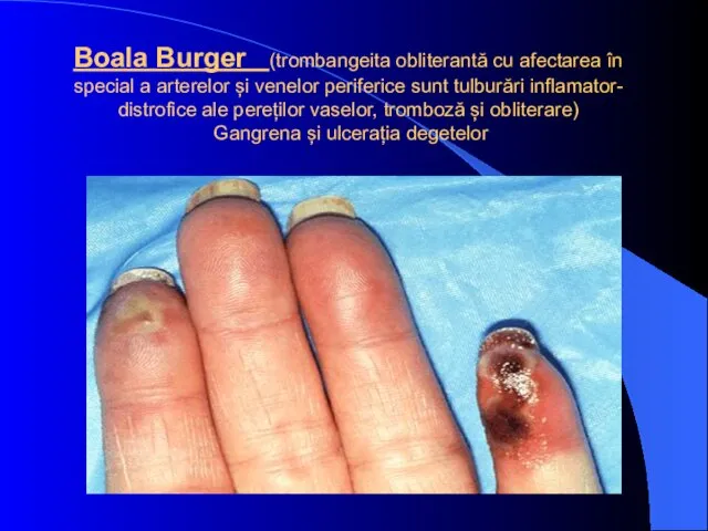 Boala Burger (trombangeita obliterantă cu afectarea în special a arterelor