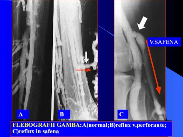 FLEBOGRAFII GAMBA:A)normal;B)reflux v.perforante; C)reflux in safena A B C V.SAFENA