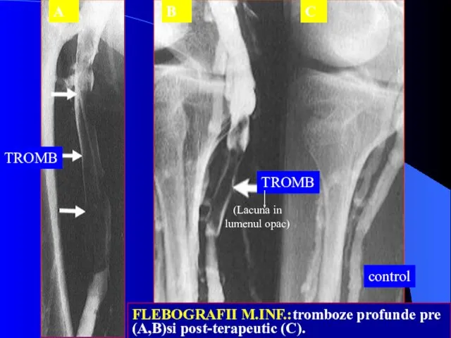 FLEBOGRAFII M.INF.:tromboze profunde pre (A,B)si post-terapeutic (C). A B C