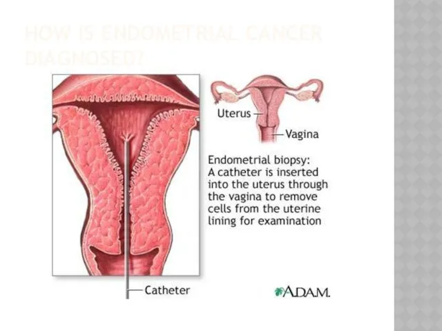 HOW IS ENDOMETRIAL CANCER DIAGNOSED?