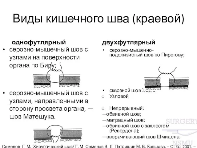 Виды кишечного шва (краевой) однофутлярный серозно-мышечный шов с узлами на