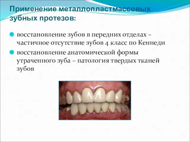 Применение металлопластмассовых зубных протезов: восстановление зубов в передних отделах – частичное отсутствие зубов