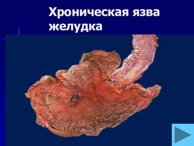 Хроническая язва желудка