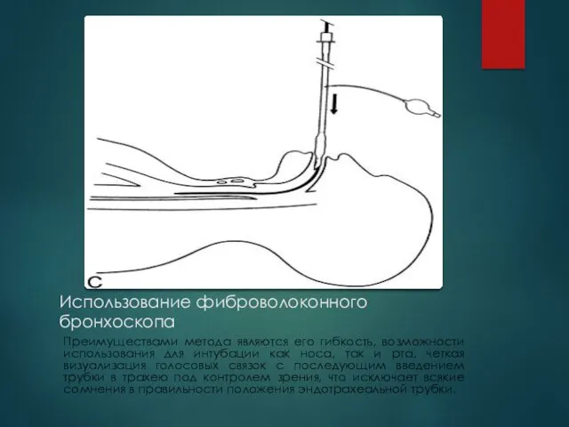 Использование фиброволоконного бронхоскопа Преимуществами метода являются его гибкость, возможности использования