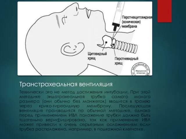 Транстрахеальная вентиляция Технически это не метод достижения интубации. При этой